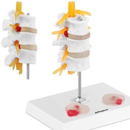 Model anatomiczny 3D odcinka lędźwiowego kręgosłupa z przepukliną kręgi 3-5